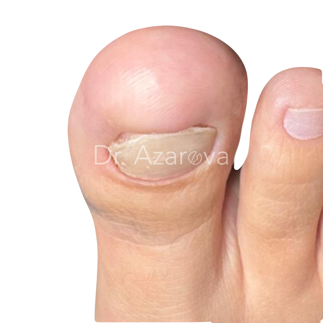 экзостоз подногтевой фото
