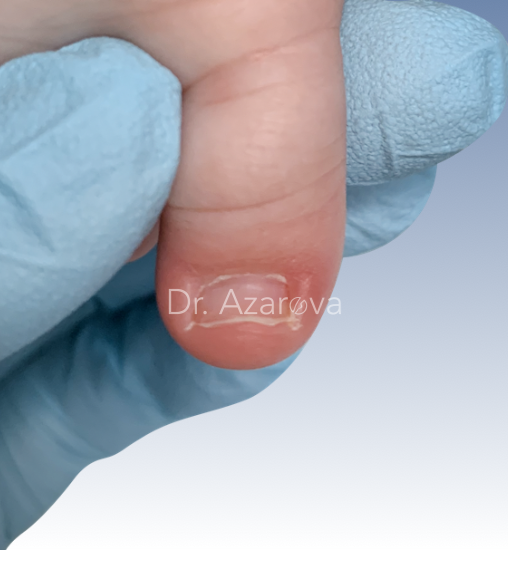 Вросший ноготь у младенца вросший ноготь, вросший ноготь у ребенка, детский подолог, удаление вросшего ногтя, лечение вросшего ногтя