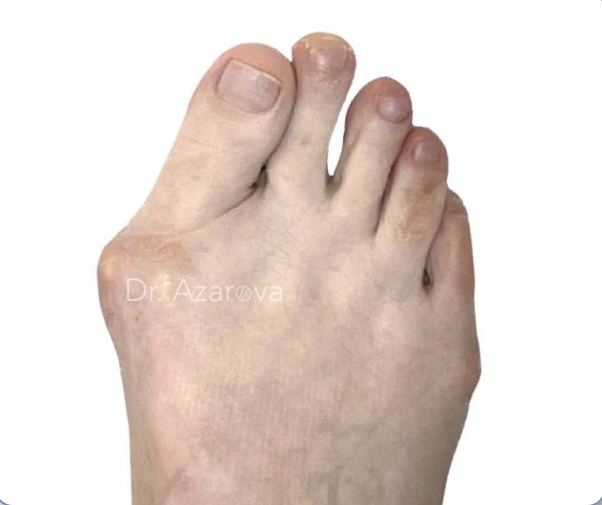 Халюс Вальгус: что это такое, причины, симптомы, лечение, операция, восстановление, доктор Азарова, врач подолог хирург