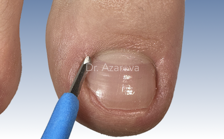 Лечение вросшего ногтя вросший ноготь, онихокриптоз, лечение вросшего ногтя, ортониксия, титановая нить, удаление вросшего ногтя, резекция вросшего ногтя
