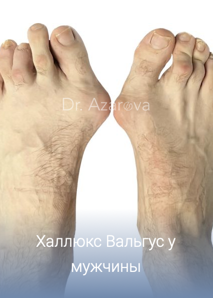 халюс Вальгус у мужчин: причины, симптомы, диагностика, лечение, профилактика, врач подолог хирург