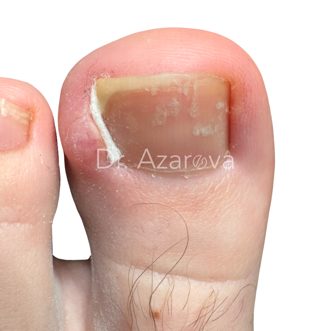 Вросший ноготь на большом: причины, симптомы, диагностика, лечение, удаление, операция, фото, отзывы, врач подолог хирург
