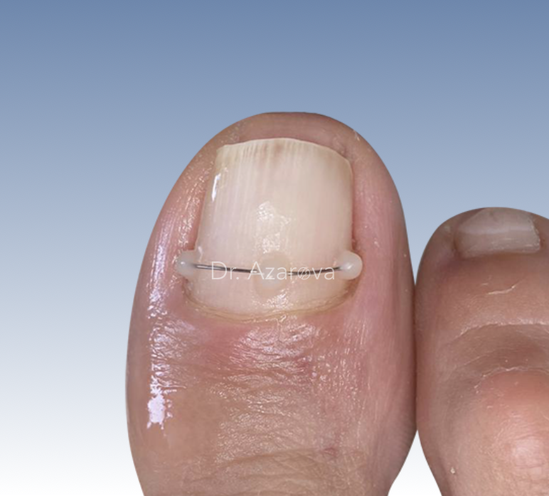 Титановая нить вросший ноготь, онихокриптоз, титановая нить, ортониксия, скоба Фрезера, лечение вросшего ногтя, ортониксия, корреляционные системы, титановая нить