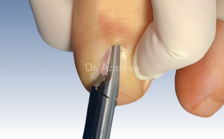 Удаление вросшего ногтя вросший ноготь, онихокриптоз, титановая нить, ортониксия, скоба Фрезера, лечение вросшего ногтя, ортониксия, титановая нить, удаление вросшего ногтя, лечение вросшего ногтя, резекция вросшего ногтя