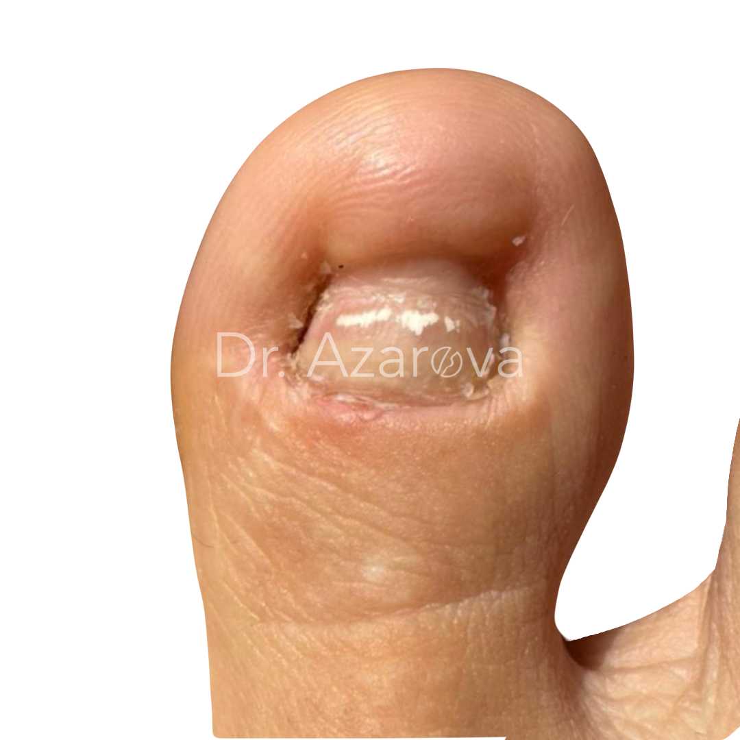 Экзостоз подногтевой: причины, симптомы, диагностика, лечение, удаление, операция, фото, отзывы, лучшие врачи