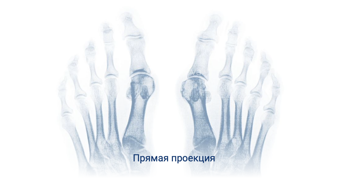 рентген стопы с нагрузкой