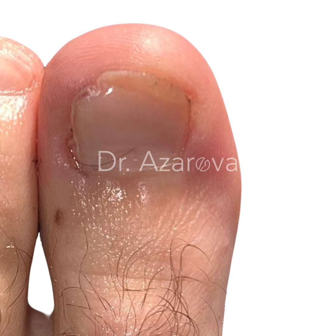 вросший ноготь результаты лечения, вросший ноготь на ноге, лечение вросшего ногтя, удаление вросшего ногтя, удаление ногтя, до и после, лечение до и после