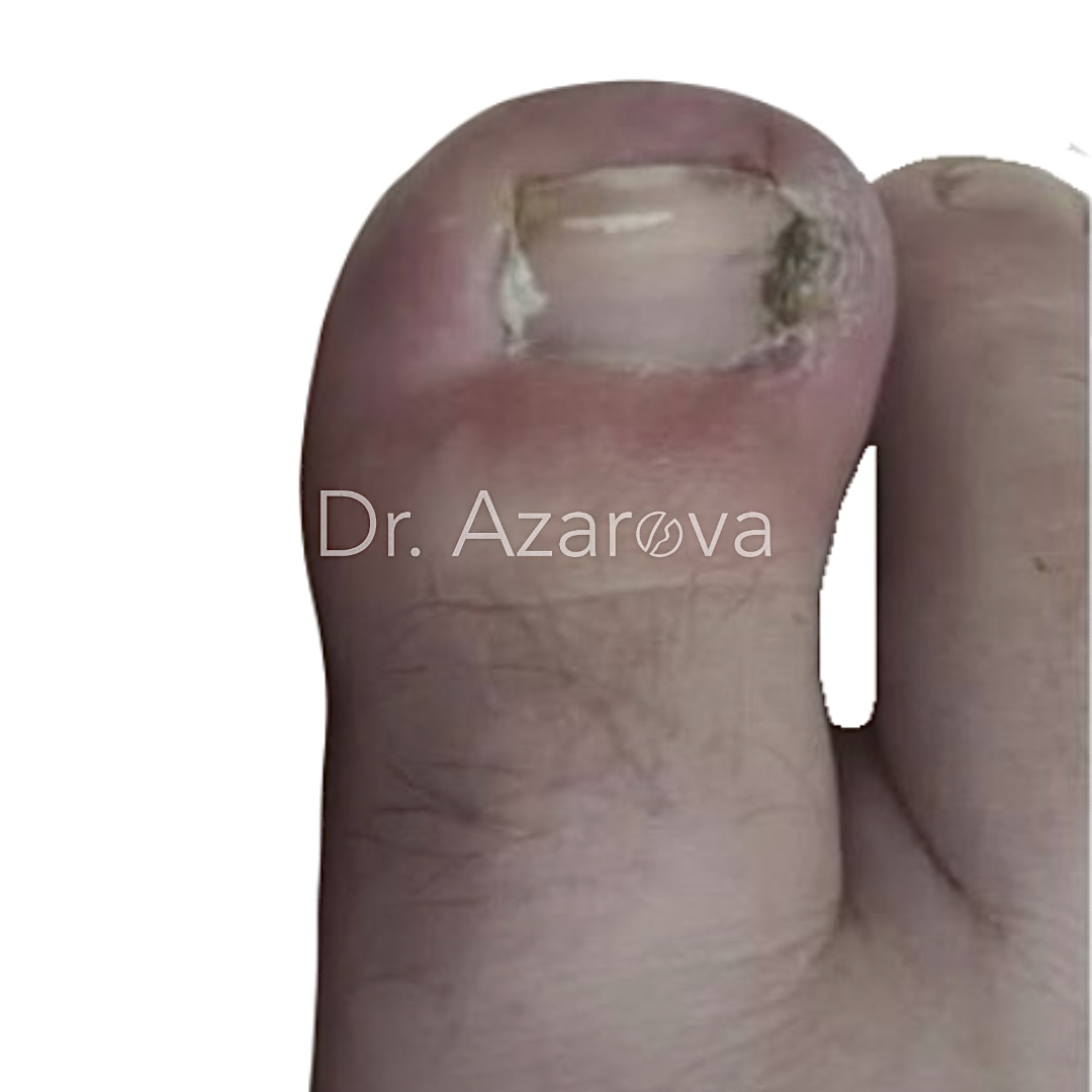 вросший ноготь результаты лечения, вросший ноготь на ноге, лечение вросшего ногтя, удаление вросшего ногтя, удаление ногтя, до и после, лечение до и после