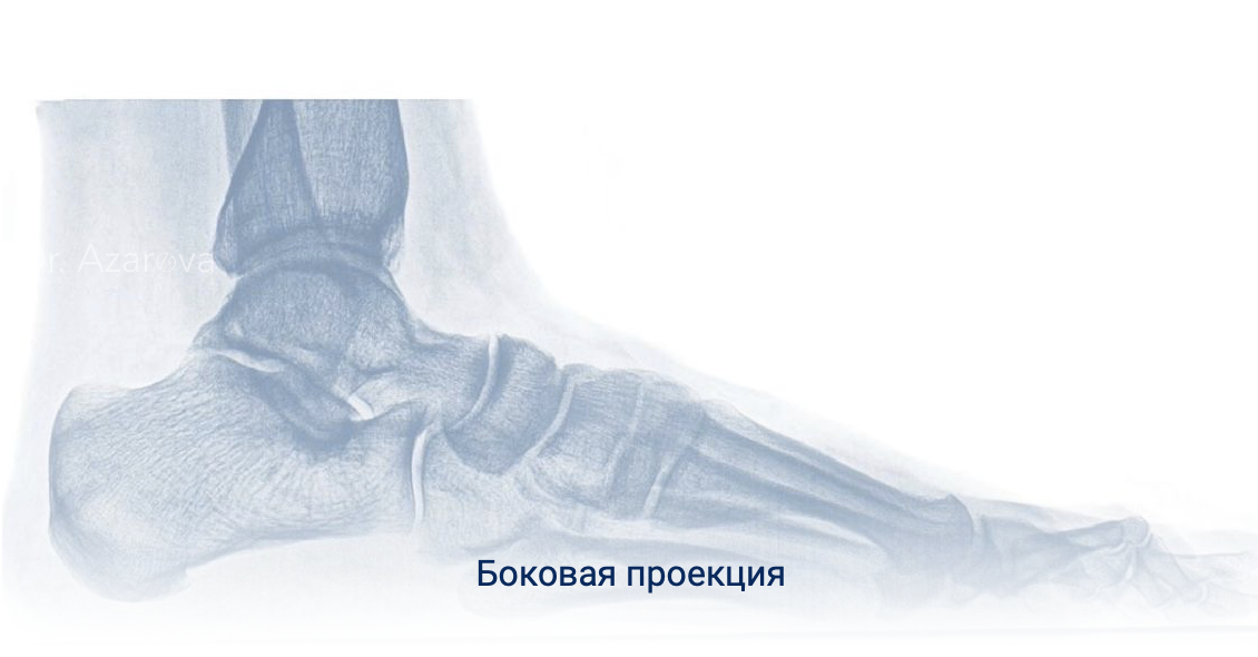 рентген стоп сбоку