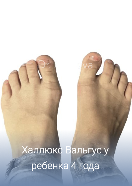 халюс Вальгус у детей: причины, симптомы, диагностика, лечение, профилактика, врач подолог хирург