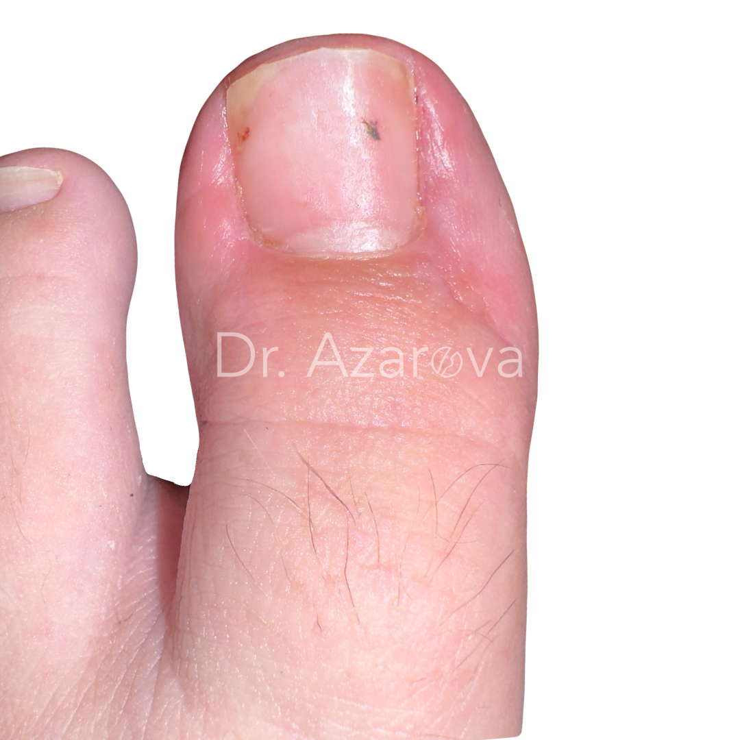 вросший ноготь результаты лечения, вросший ноготь на ноге, лечение вросшего ногтя, удаление вросшего ногтя, удаление ногтя, до и после, лечение до и после