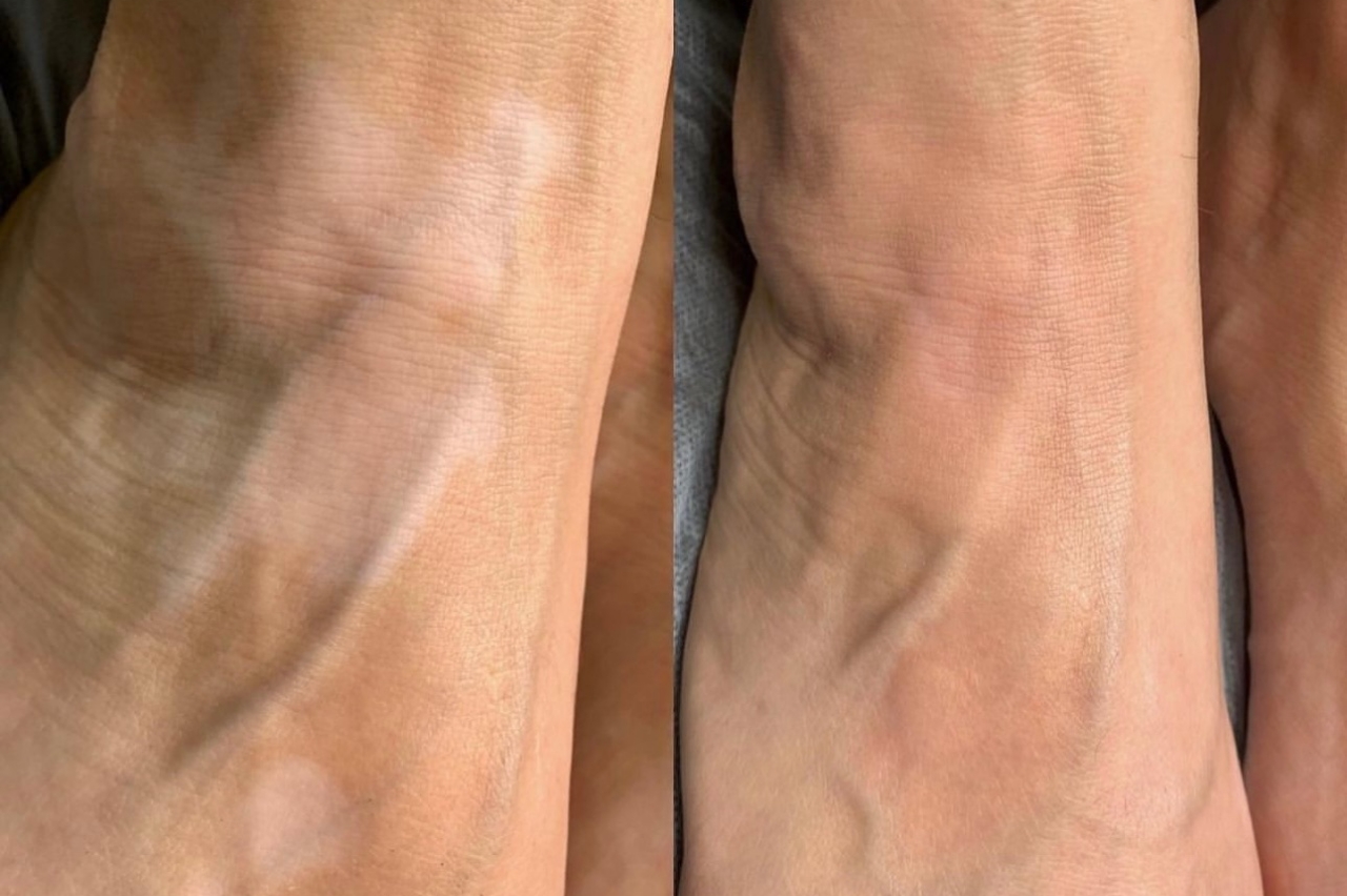 камуфляж витилиго москва камуфляж витилиго москва