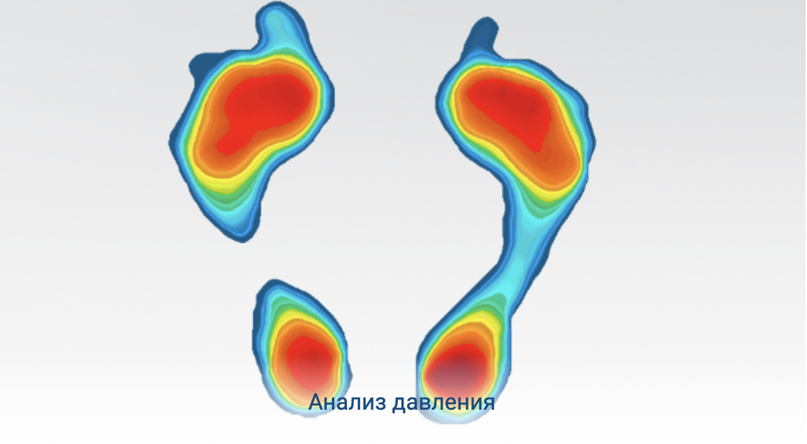 анализ плантарного давления, отпечаток стопы