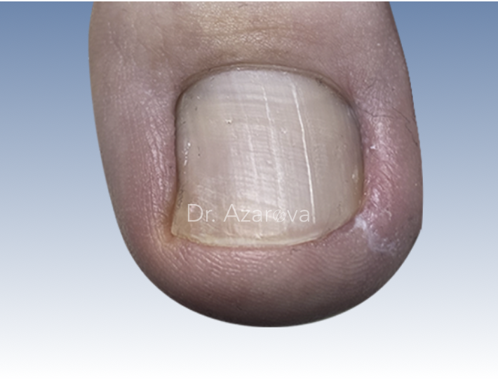 Вросший ноготь симптомы вросший ноготь симптомы, онихокриптоз, лечение вросшего ногтя, удаление вросшего ногтя, стадии вросший ноготь, удаление ногтя, вросший ноготь 1 стадия