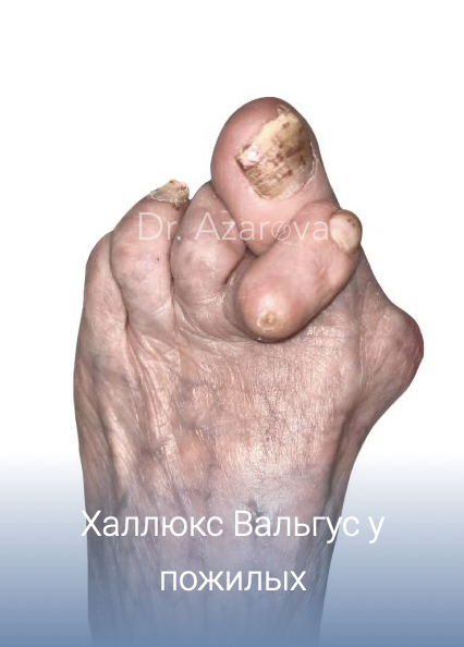 халюс Вальгус у мужчин: причины, симптомы, диагностика, лечение, профилактика, врач подолог хирург