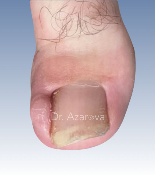 Фиброма при хроническом вросшем ногте вросший ноготь, хронический вросший ноготь, удаление вросшего ногтя, лечение вросшего ногтя