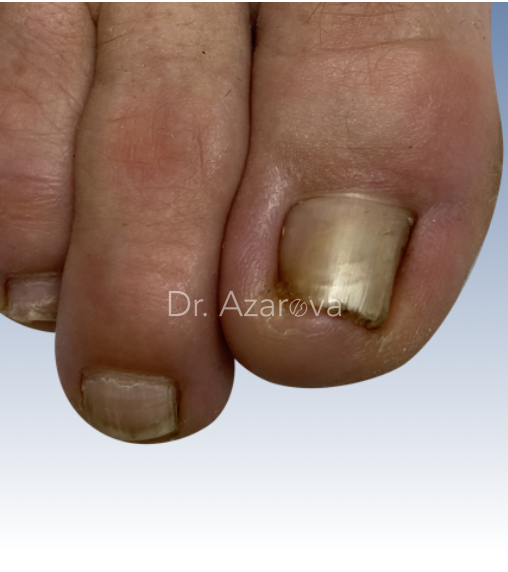 Вросший ноготь климактерический скрученный вросший ноготь, скрученный вросший ноготь, пинцирный ноготь, удаление вросшего ногтя, лечение вросшего ногтя, ортониксия, титановая нить