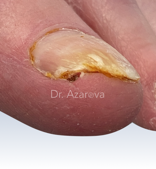 Вросший ноготь у пациентов с нарушением кровообращения вросший ноготь, вросший ноготь и плохое кровообращение, удаление вросшего ногтя, лечение вросшего ногтя
