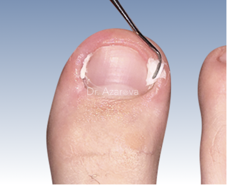 Тампонада ногтя вросший ноготь, онихокриптоз, лечение вросшего ногтя, тампонирование вросшего ногтя, тампонада вросшего ногтя