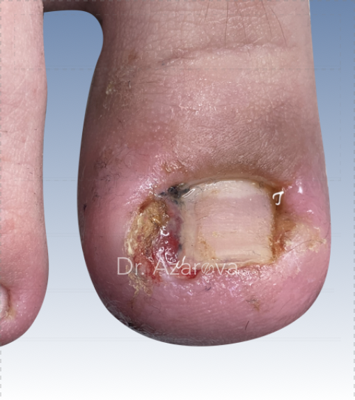 Вросший ноготь у подростка вросший ноготь, вросший ноготь у подростка, удаление вросшего ногтя, лечение вросшего ногтя