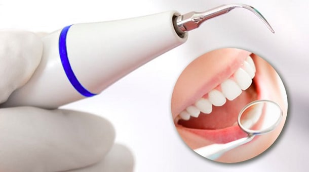 chistka zubov tsena