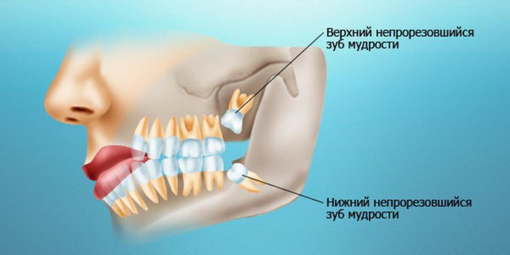 Заживление десны после удаления зуба